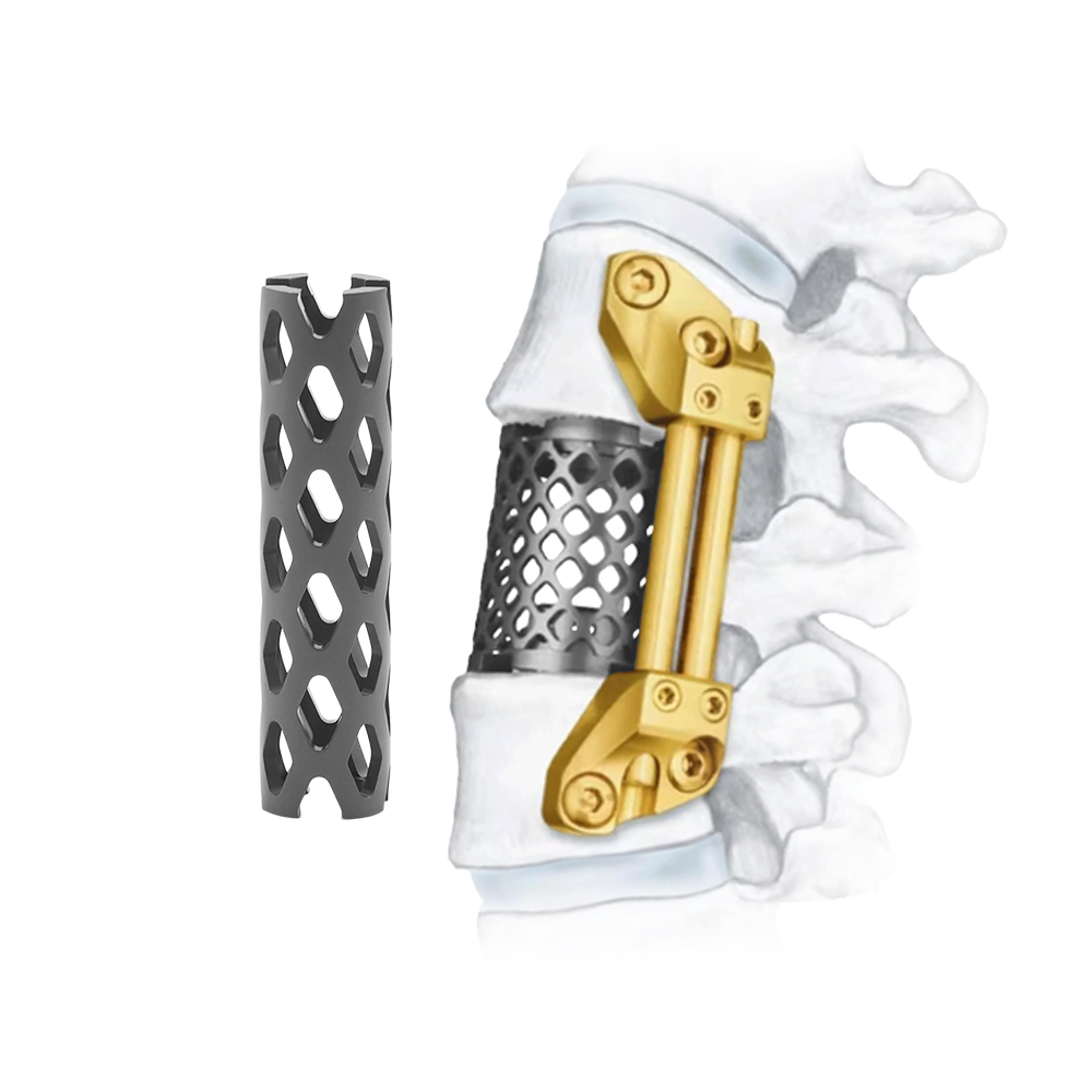Geasure Medical-Grade Titanium Cervical Mesh Is Used in Cervical Interbody fusion Surgery