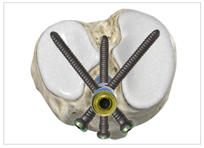 Multi-point fixation