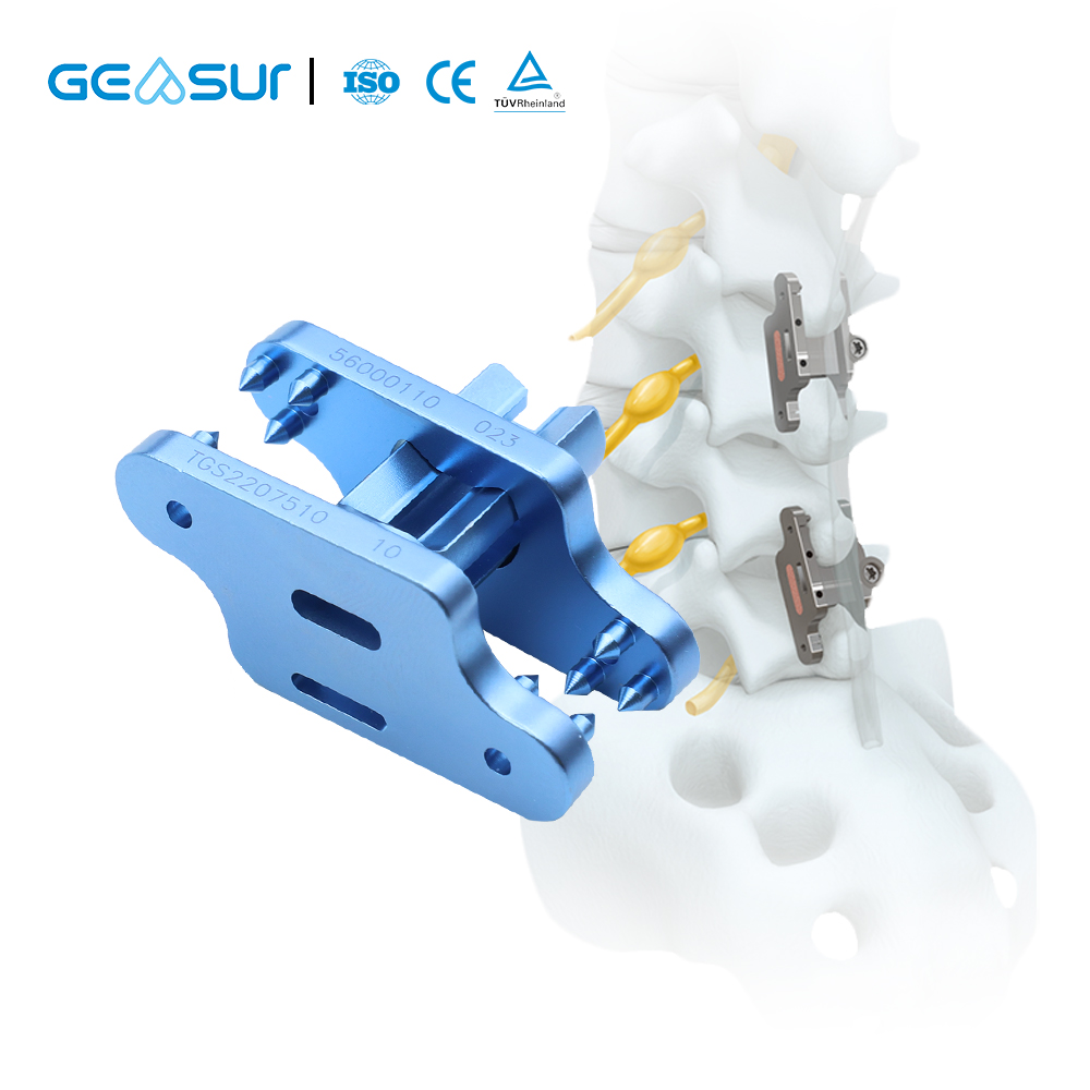 Geasure Orthopedic Implant InterFuse Semi-rigid Titanium Alloy Interspinous Fusion System Size 8-16mm for Degenerative Disc