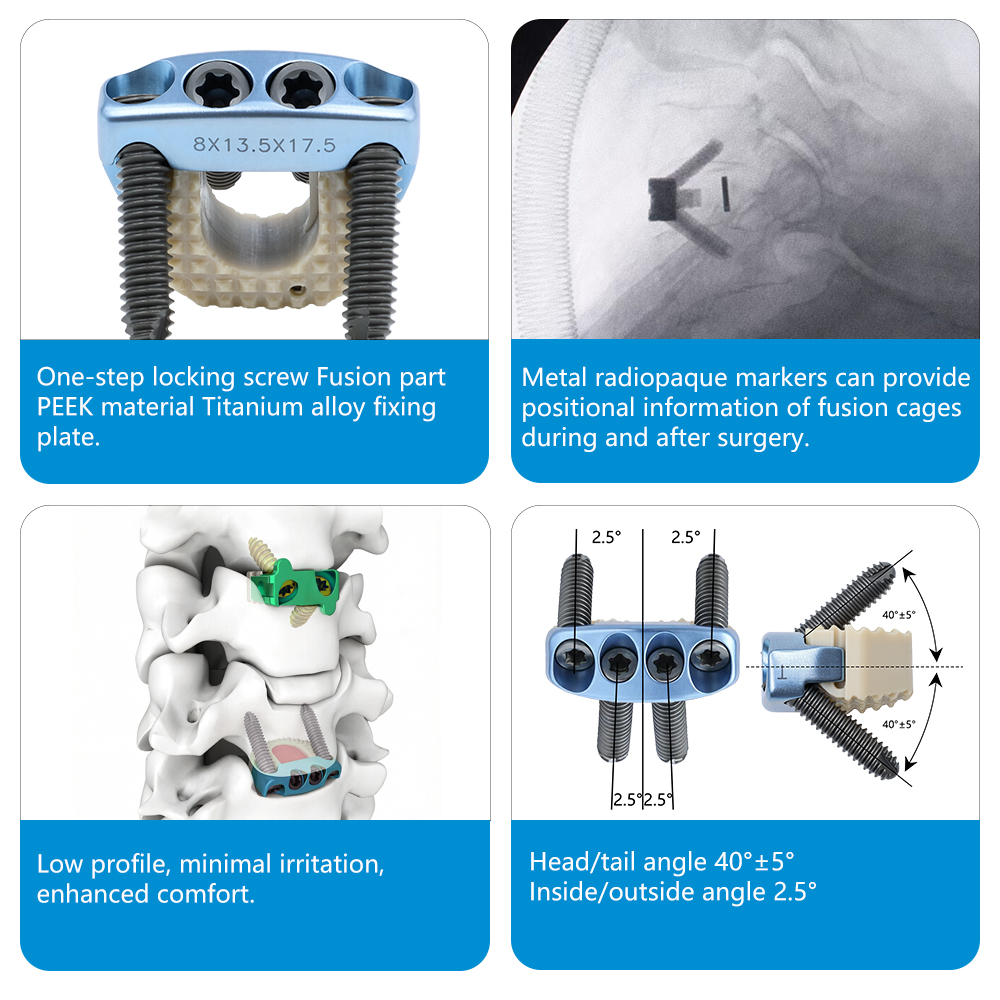 CE ISO Certified Class III Zero Profile Spinal Fusion Cage Medical Grade PEEK Titanium Alloy Cervical Interbody Fusion Device