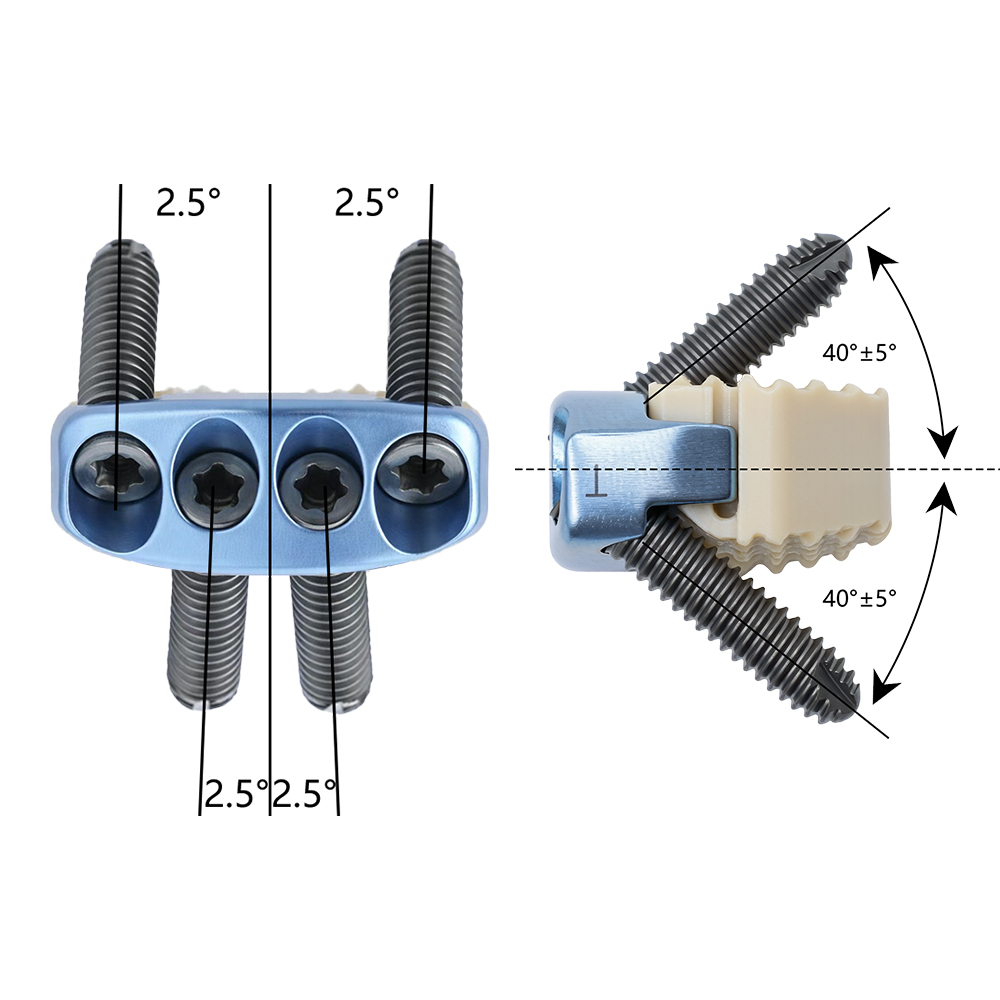 CE ISO Certified Class III Zero Profile Spinal Fusion Cage Medical Grade PEEK Titanium Alloy Cervical Interbody Fusion Device