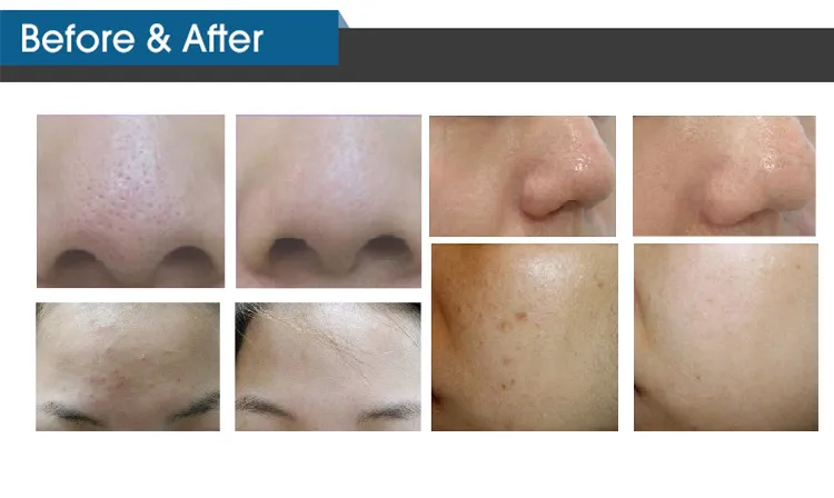 Hydra Spring Device 4