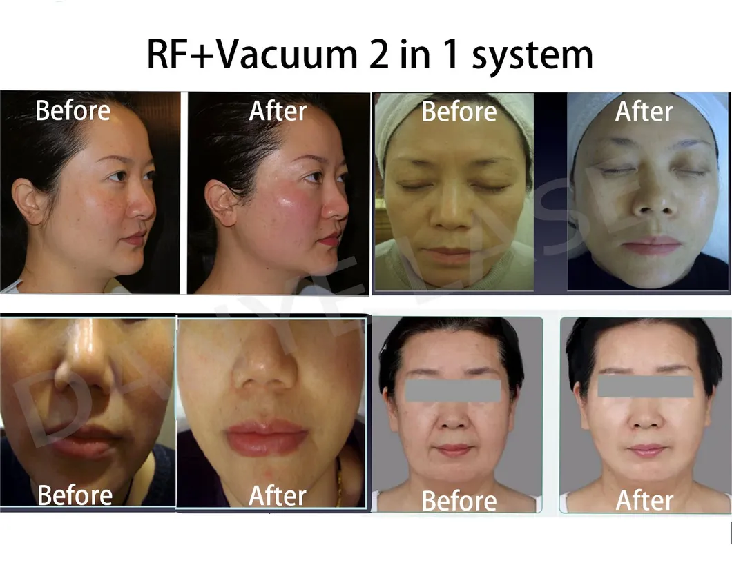 Handpiece Specification