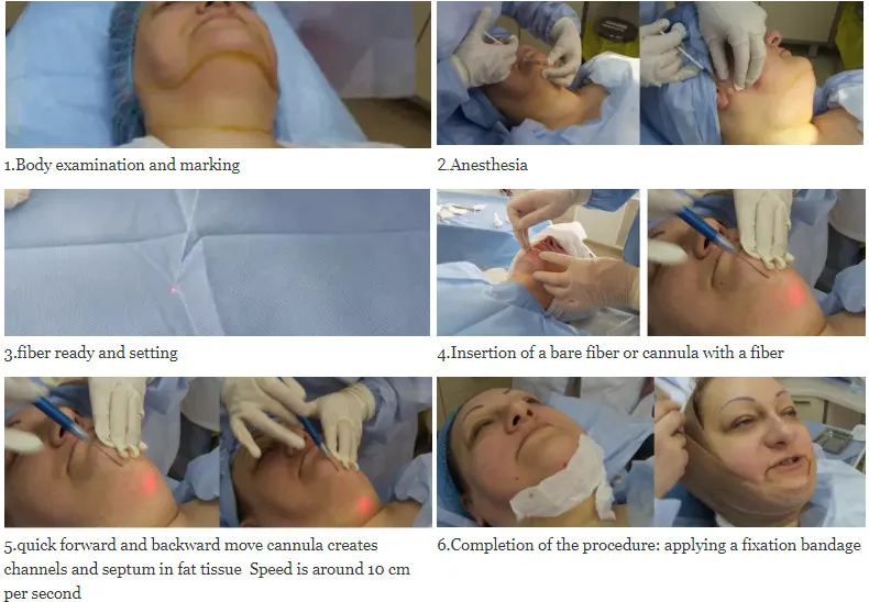 Procedure Steps