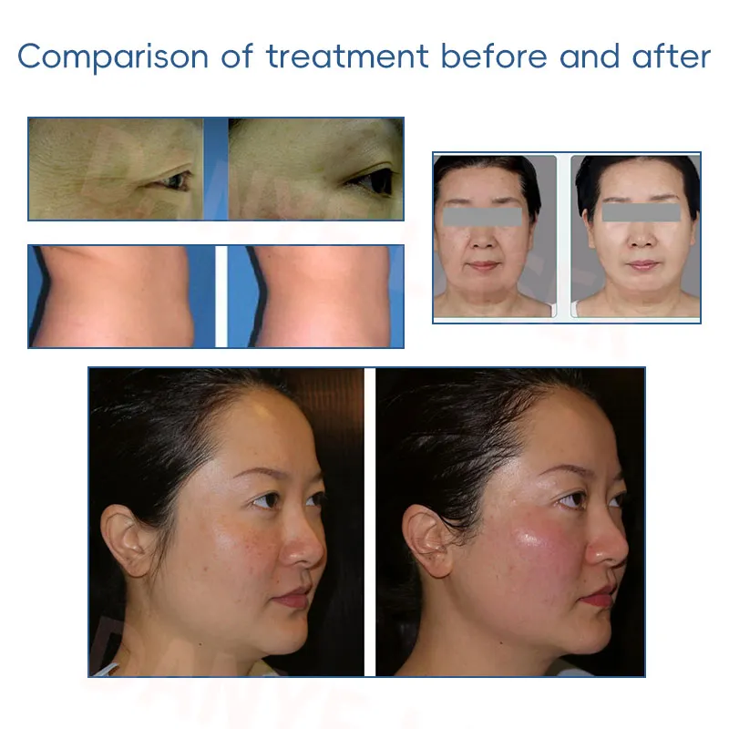 Before and After Results