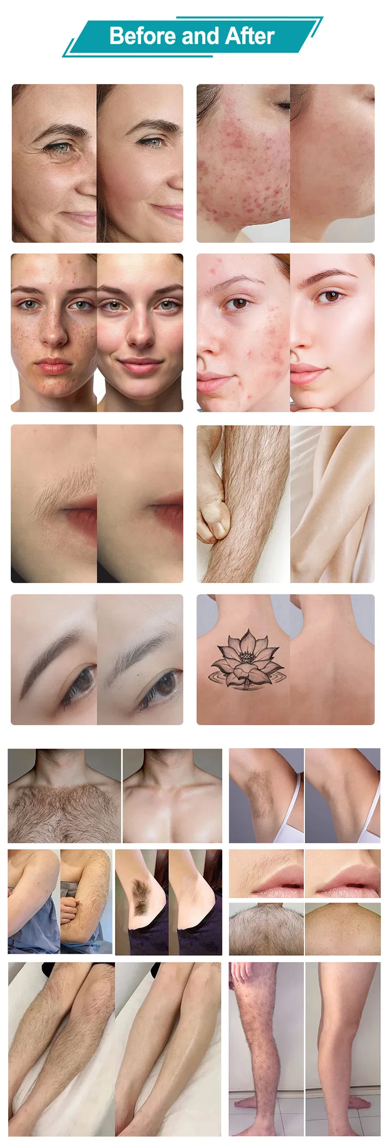 808nm Hair Removal Machine 11