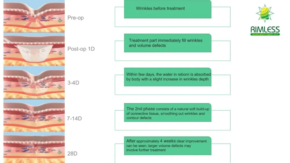 PLLA Dermal Filler Application