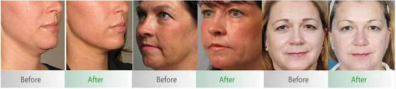 Before and After Results