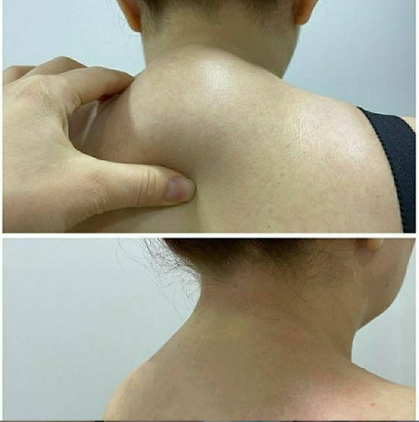 2026 Factory Price 47W Endolifting Surgery 980nm 1470nm Endo Facial Lifting Device