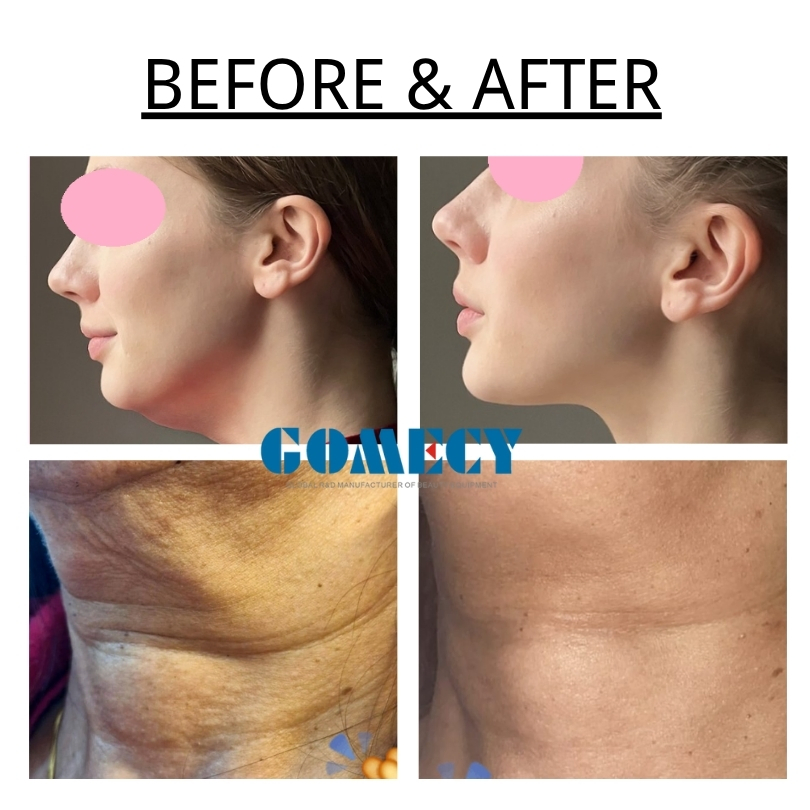 Medical Level 980nm 1470nm Mixing Power Endolift Laser Skin Beauty Equipment