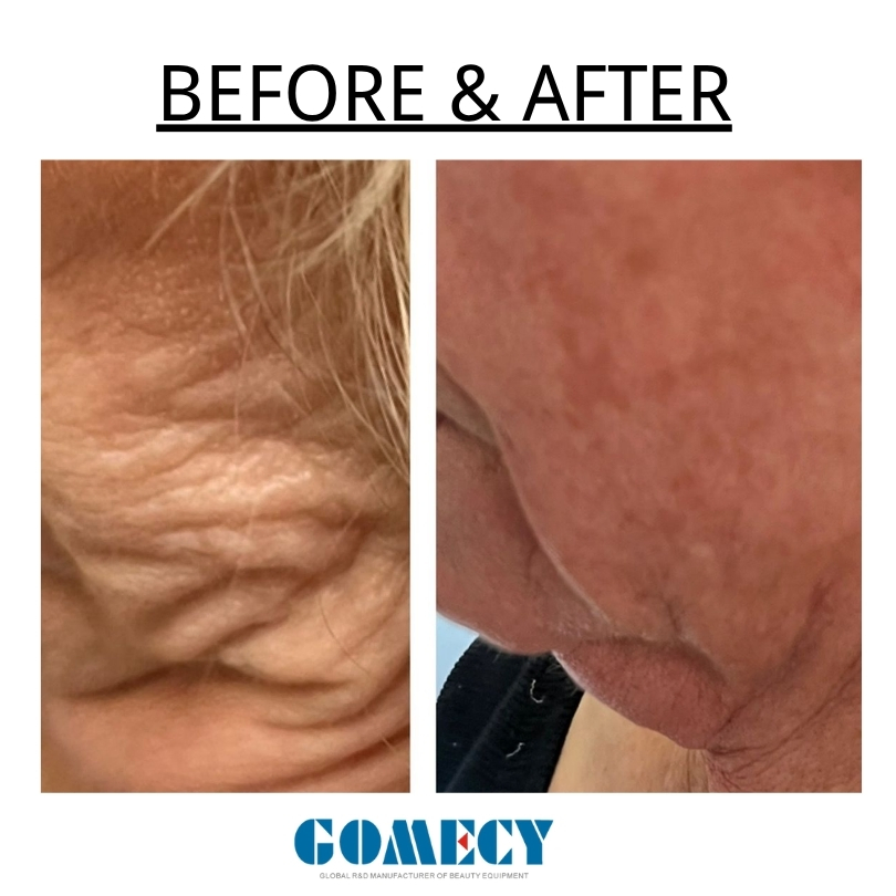 Double Chin Shaping 1470nm Endolift Laser Evlt Lipolysis Liposuction Vascular Remove