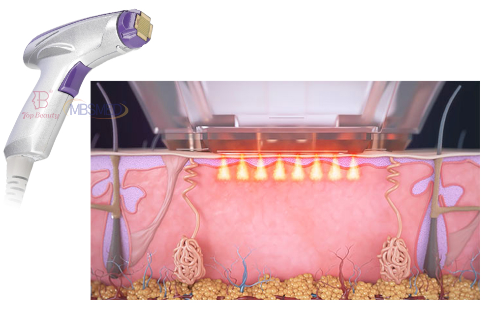Facial Wrinkle Remover Inmode Morpheus 8 Radio Frequency Fractionated RF Skin Tightening Device