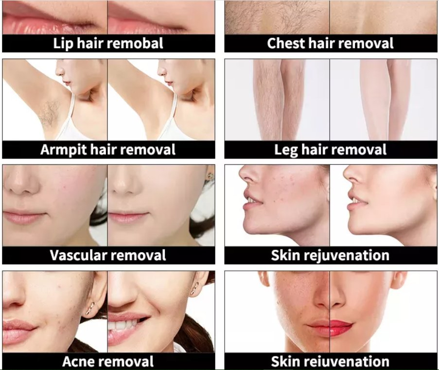 IPL+RF+ND YAG+Diode Laser 808 Alexandrite Diode Laser Hair Removal Multifunction Beauty Device