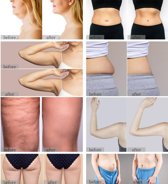 3 Handles Onda PRO Coolwave Device for Cellulite Removal Skin Tightening Onda Coolwave