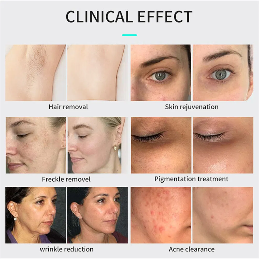 IPL Acne Pigment Wrinkle Remover Skin Rejuvenation Machine IPL Laser Hair Removal at Home