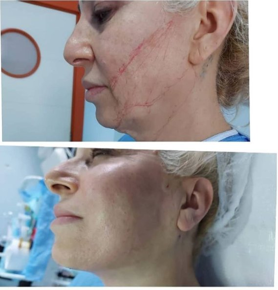 2026 Factory Price 47W Endolifting Surgery 980nm 1470nm Endo Facial Lifting Device