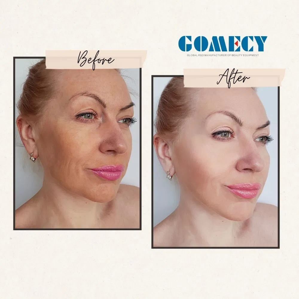 Hot Selling 7D Skin Tightening Hifu Smas Cartridges Tightening Machine Facial Lift Firming Facial Lifting New Model