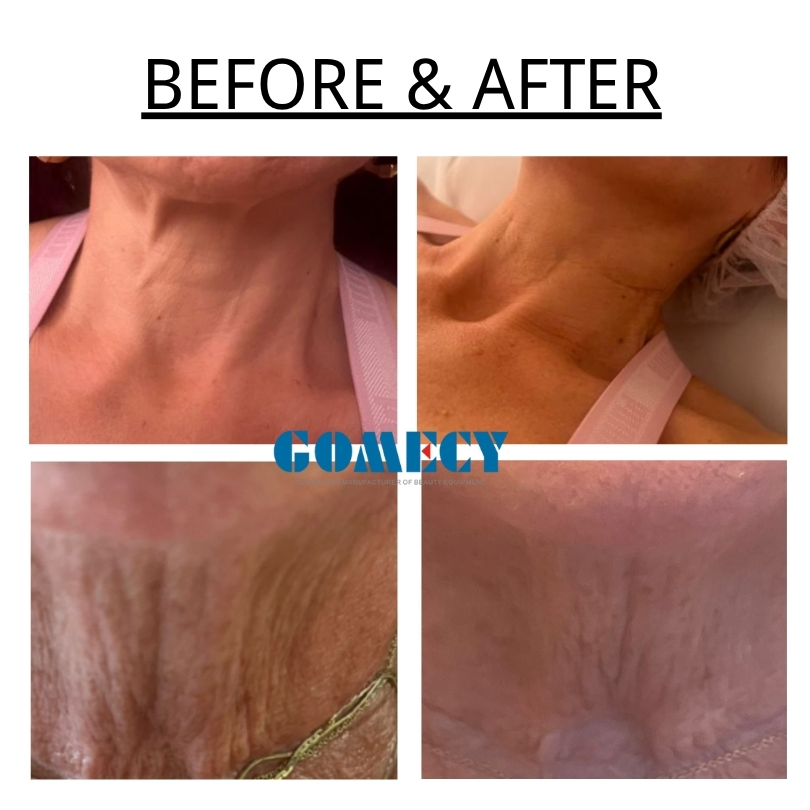 1470nm Laser Surgery Equipment Evlt 980nm 1470nm Endolift Laser Equipment Face Shaping