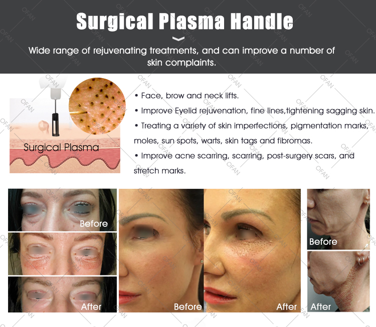 Ofan 3 in 1 Plasma Pen Eye Care Instrument Cold Plasma Skin Device