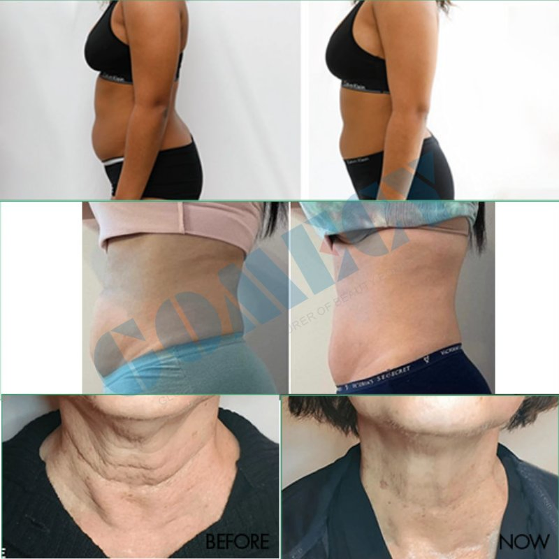 T Shock Slimming and Body Contouring Device for SPA Beauty Salon Skin Tightening Treatments