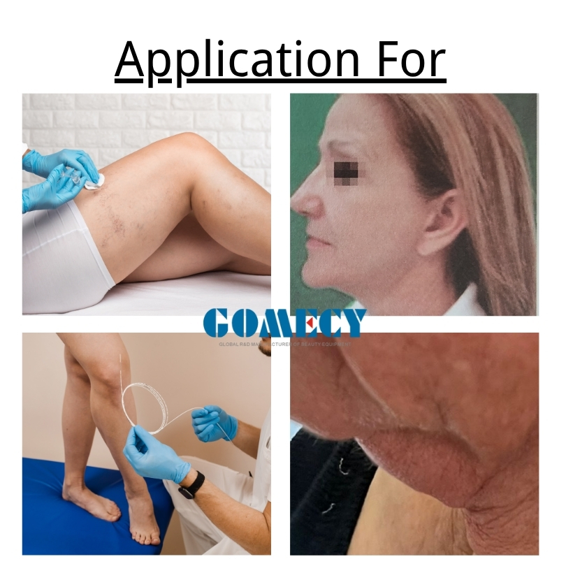 Gomecy 980nm 1470nm Laser for Face Lifting Evlt Lipolysis Medical Skin Beauty