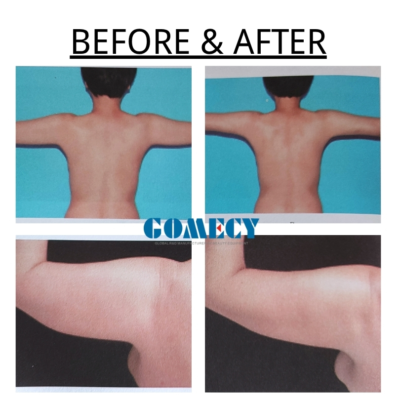 Medical Level 980nm 1470nm Mixing Power Endolift Laser Skin Beauty Equipment