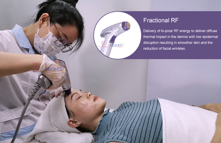 Facial Wrinkle Remover Inmode Morpheus 8 Radio Frequency Fractionated RF Skin Tightening Device