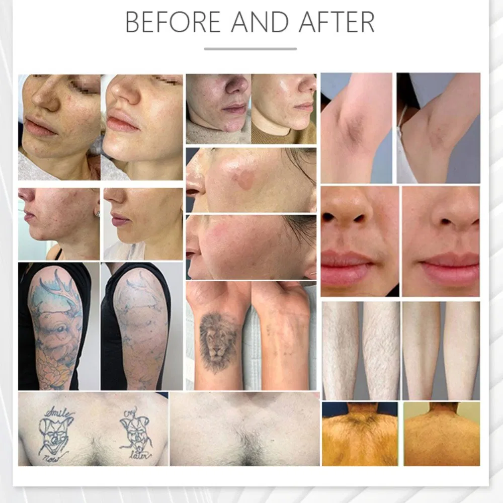 M22 Beauty Machine Pigment Removal Skin Tightening with 2 Handles Other Home Use Beauty Equipment