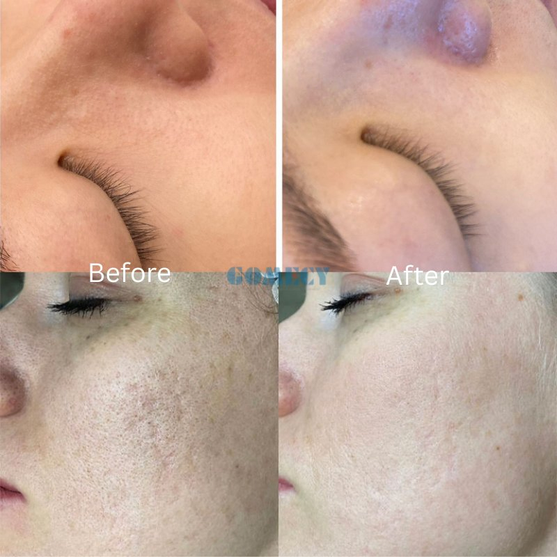 Advanced Water Drop Bubble Facial Skin Care Machine for Deep Pore Cleaning