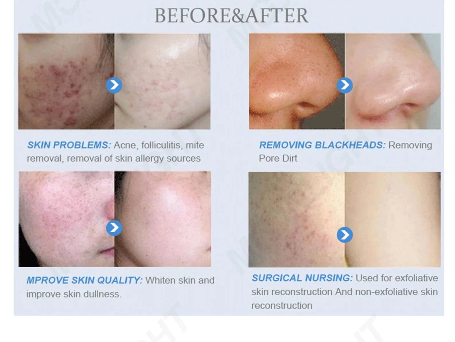 Hyperbaric Oxigeno Microdermabrasion Facial Jet Beauty Salon Skin Care Device