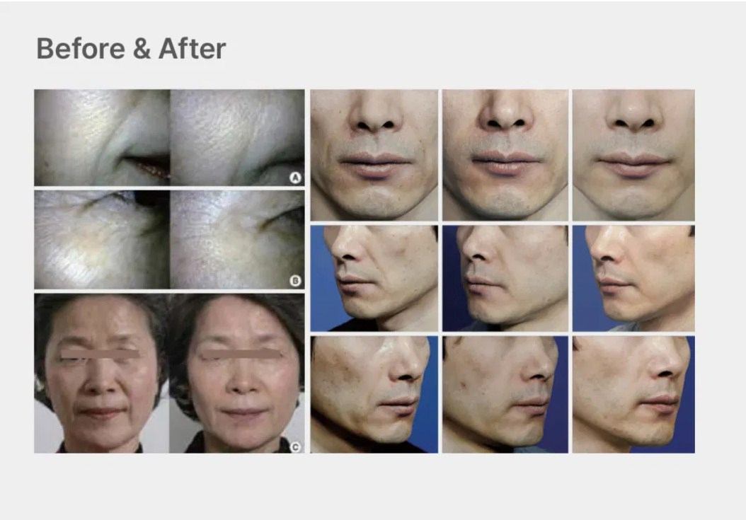 Korea Profhilo Save B32 High+Low Molecule Lifting Ha Dermal Filler 5points Face Lifting