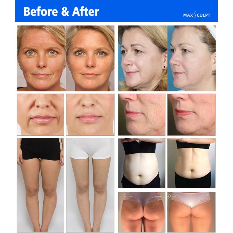 Non-Invasive Skin Tightening RF System Multifunction Body Slimming RF Device