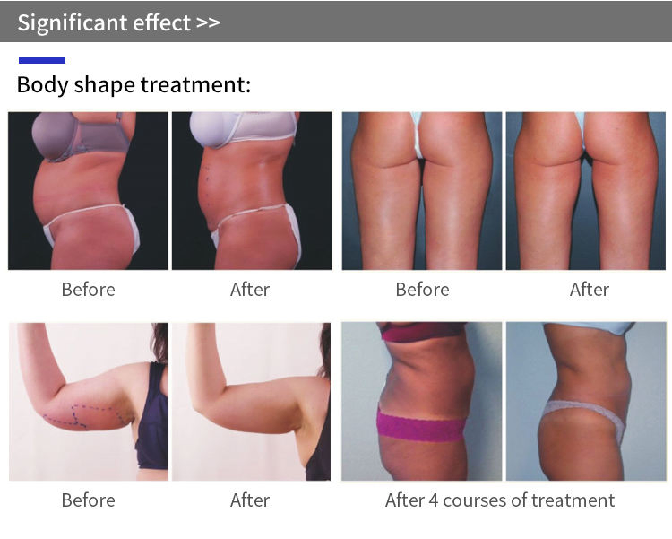 2 in 1 Vertical RF Ultrasound Face Lifting Machine Body Slimming Wrinkle Removal RF Cellulite Removal Machine