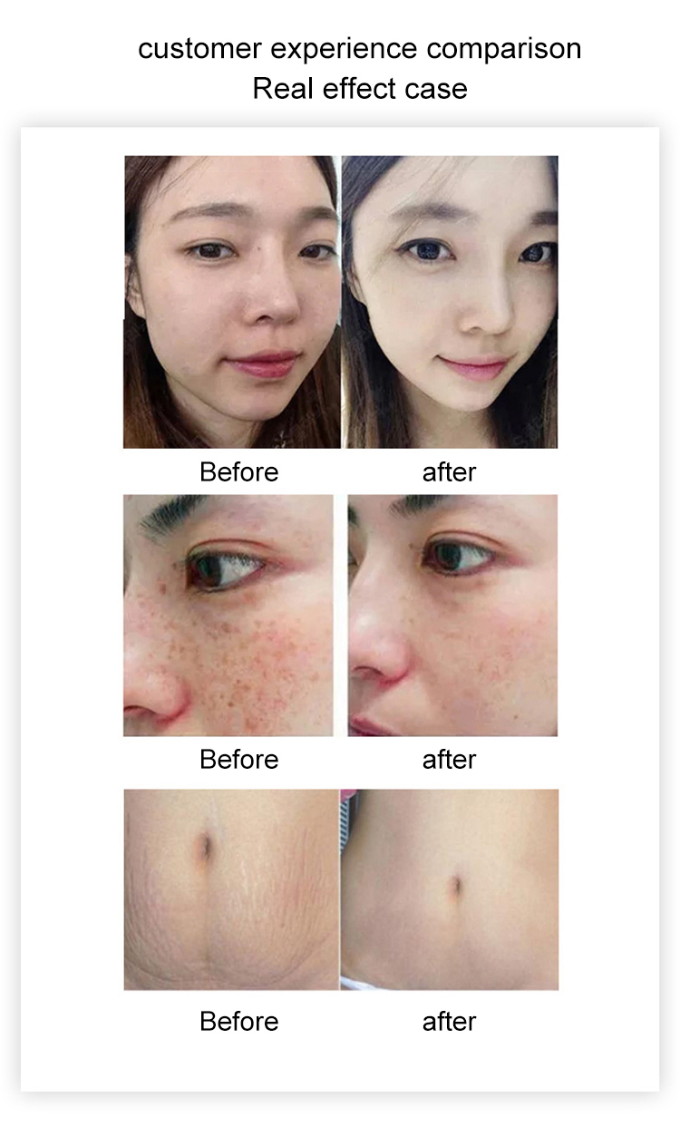 Portable Gold RF Microneedling Device Professional Skin Rejuvenation Facial Resurfacing Acne Scar Removal Treatment Radio Frequency Fractional Microneedle