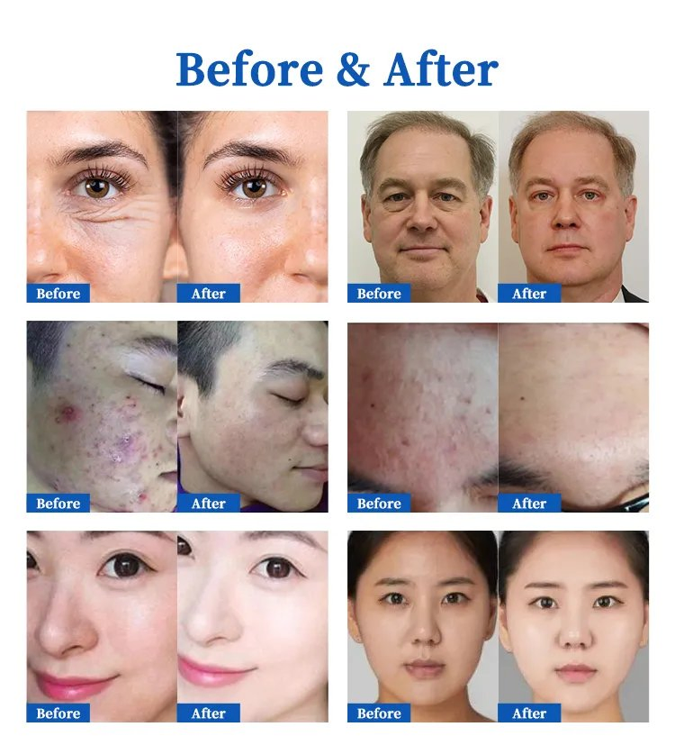 Korea Jet Plasma Cold Derm Ozone Pen Face Lift Skin Care Acne Derma Pin Laser Light Ions RF Waterproof EMS Ultrasound Instrument Cold Plasma Device