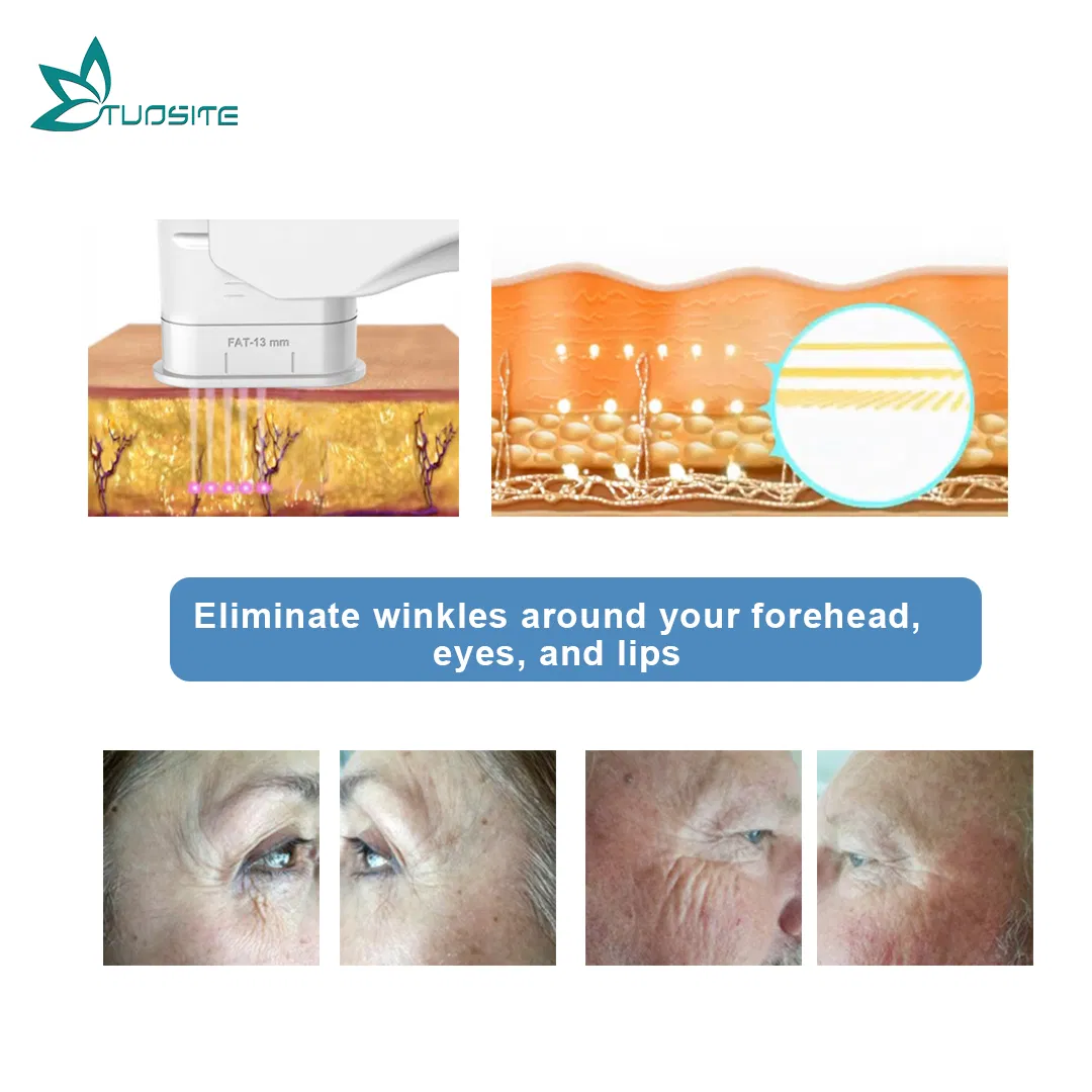 Professional Face Lift Skin Tightening Hifu Machine for Home Use