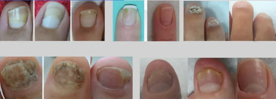 Nail Fungus Treatment