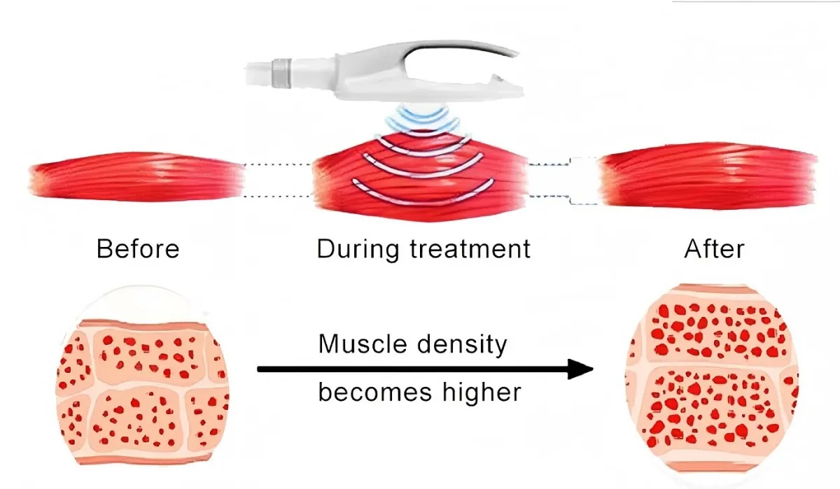 EMS Pulse System