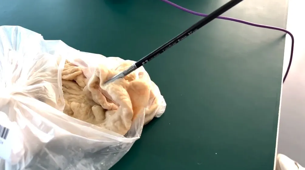 Electrosurgical Skin Cauterization Machine