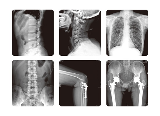 Medical High Frequency X-ray Radiograph System, Dr System (PLX8500C-202)