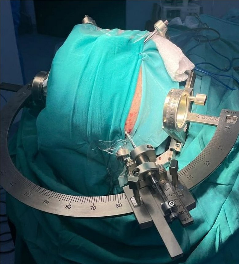 Neurosurgery Stereotactic Frame System with New Software