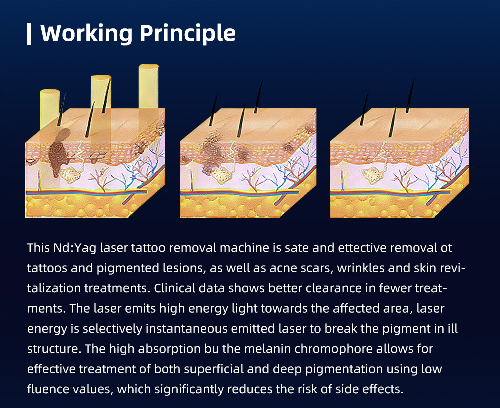 Picosecond NdYAG Laser for Removing Dark Spots and Anti-Freckles