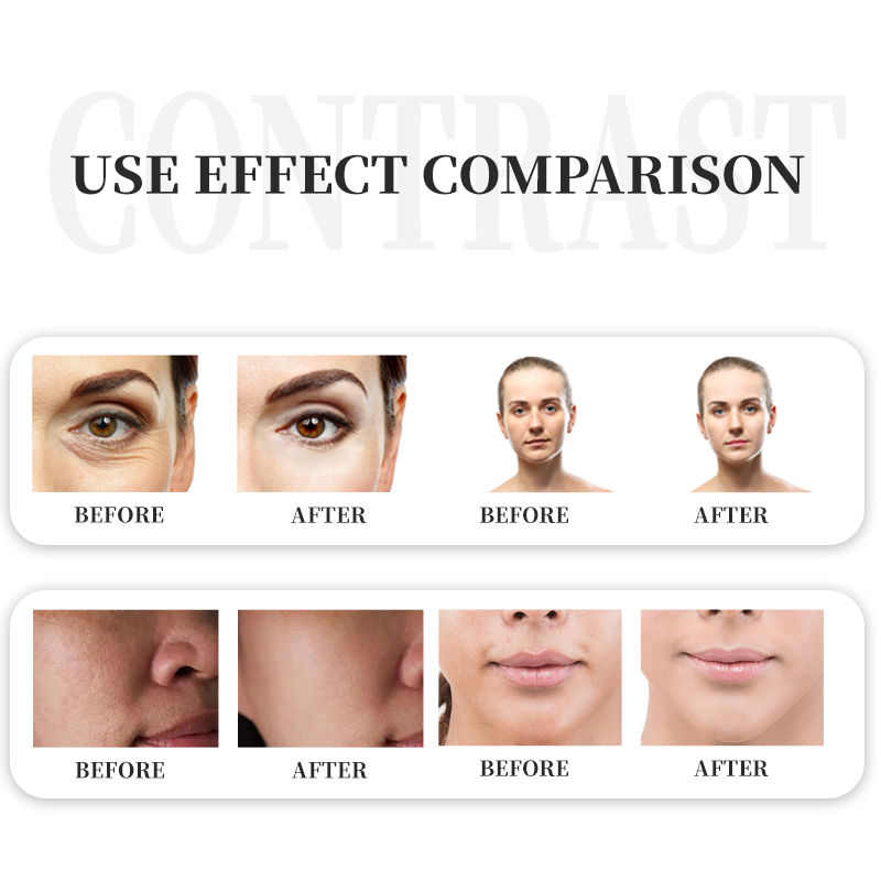 2025 Latest 1470nm Fractional Laser 1470 nm for Skin Tightening Wrinkle Removal Machine 1470 nm Beauty Laser