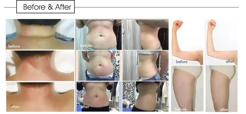 2024 Vela Body Shape Slimming Ultrasound Cavitation Vacuum Roller RF Beauty Machine Equipment Weight Loss Body Shaping