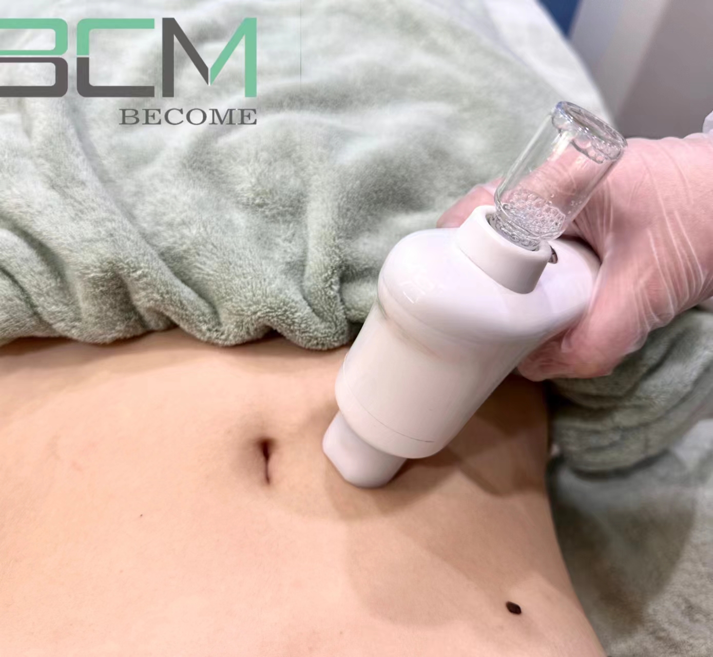 V-Lift Treatment Step 2