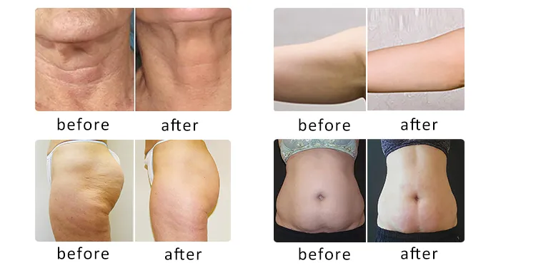 5 In1 Body Sculpt Slimming Shaping Vela RF Roller Vacuum Ultrasound Cavitation Shape Weight Fat Loss Beauty Machine