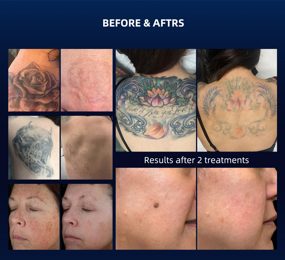 Picosecond NdYAG Laser for Removing Dark Spots and Anti-Freckles