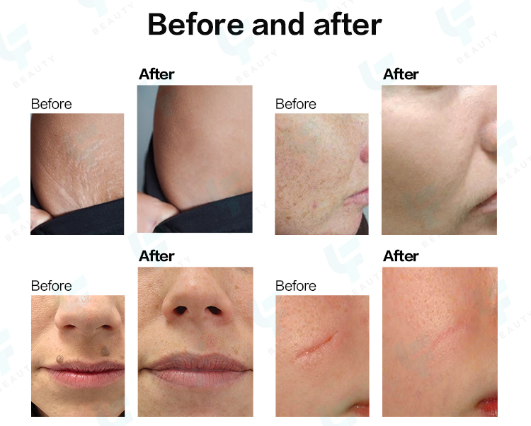 Discounted Price Fractional CO2 Laser Machine Skin Resurfacing Acne Removal Anti-aging Portable CO2 Fractional Laser Device