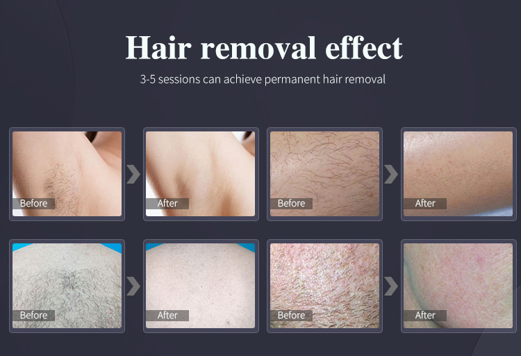 Beijing 2026 Diode Laser Machine 1800W Diode Laser Hair Remove 1064nm 755nm 808nm Diode Laser Hair Removal