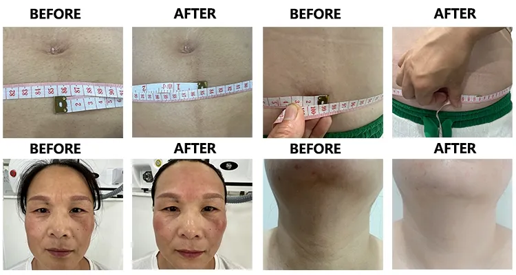 Before and After Treatment